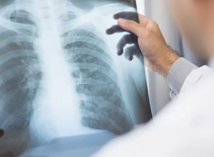 anvisa-aprova-novo-medicamento-para-cancer-de-pulmao-avancado